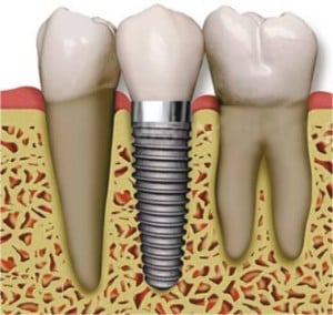 dental-implant