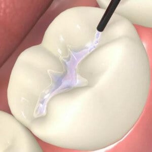 Dental Sealants