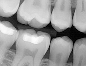 Digital Dental Xrays