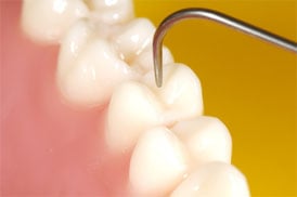 Composite Fillings