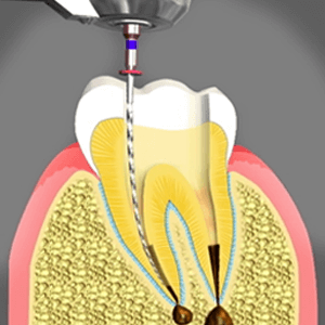 rct-treatment.jpg