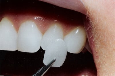 Dental Veneers