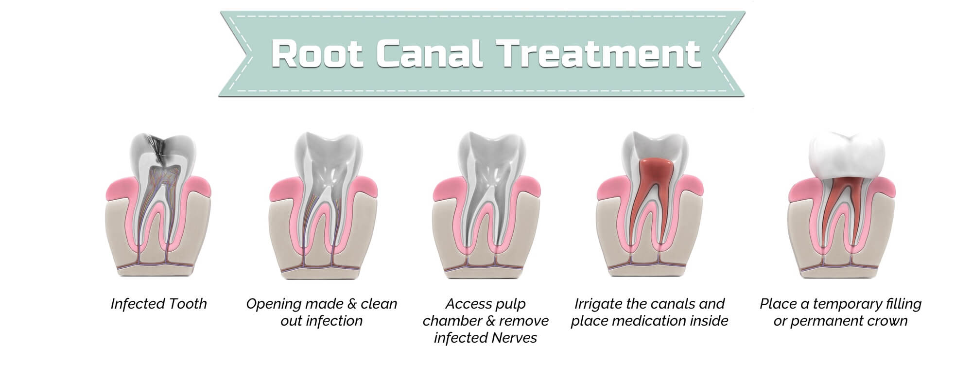 Root Canal Treatment Procedure