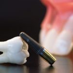 Should I Choose Dental Implants?