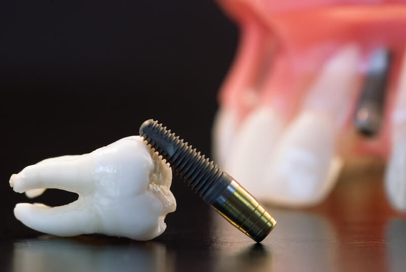 Should I Choose Dental Implants?