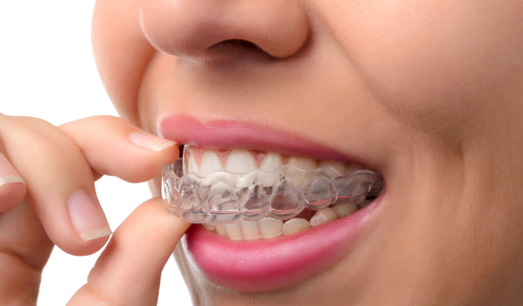 5 Signs You May Need to Wear a Mouth Guard at Night