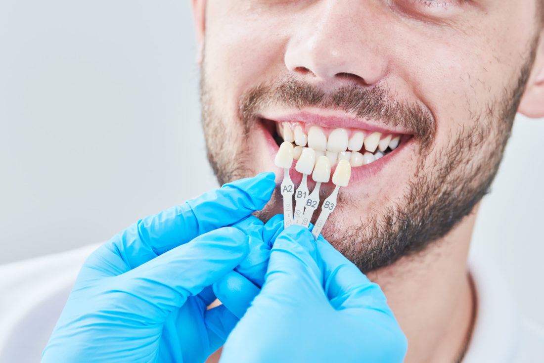 Dental Veneers: 7 Amazing Benefits of Veneers You Did Not Know