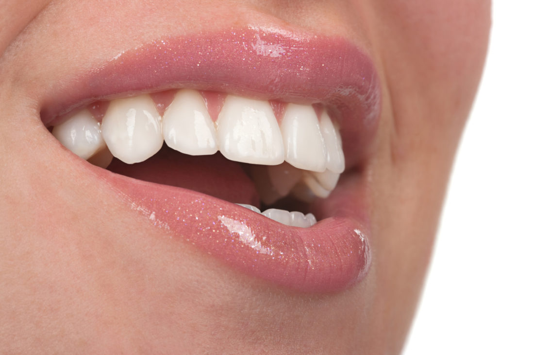 6 Dental Veneer Maintenance Mistakes to Avoid for New Users