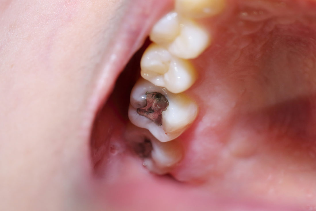 Old Dental Filling Fell Out? Here’s What to Do.