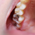 Old Dental Filling Fell Out? Here’s What to Do.