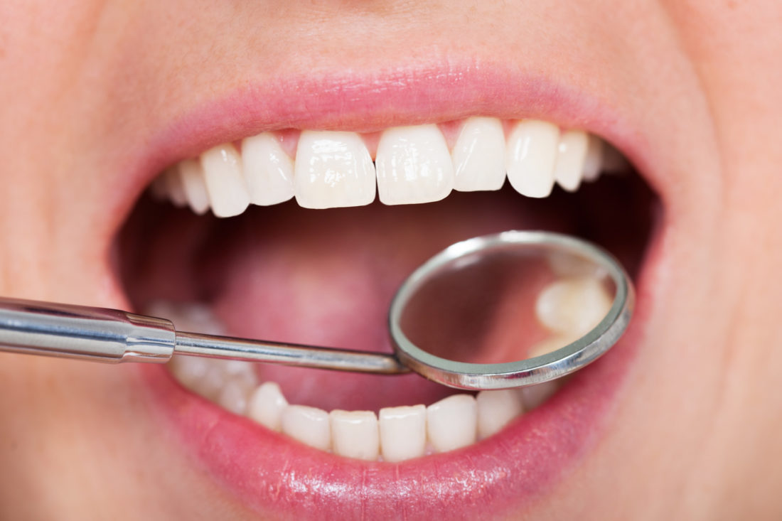 All You Need to Know About Composite Fillings and How to Care For Them