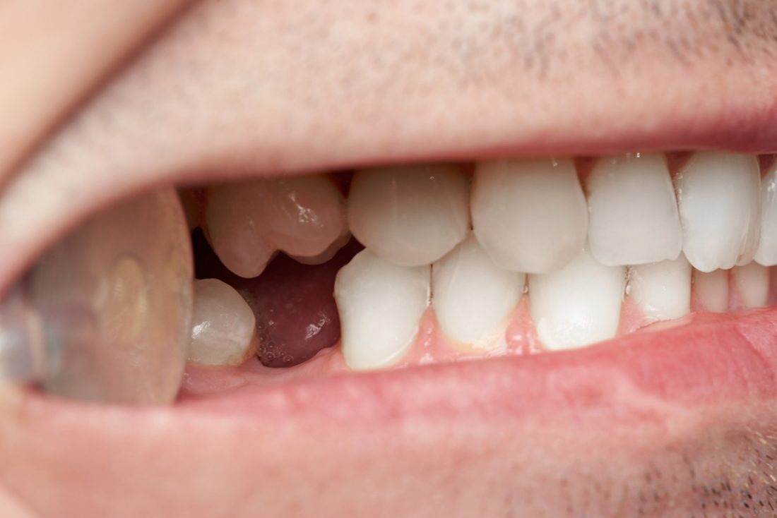 A Brief Guide to The Different Teeth Replacement Options