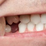 A Brief Guide to The Different Teeth Replacement Options