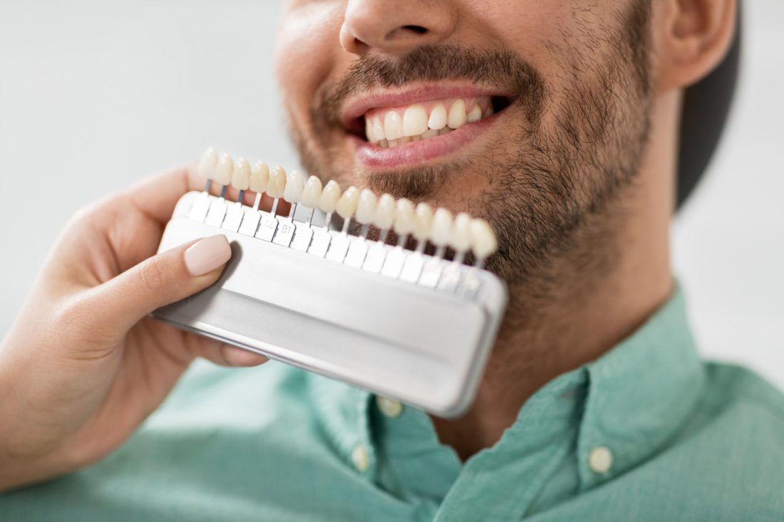 How Often Do Veneers Need to Be Replaced? A Simple Guide